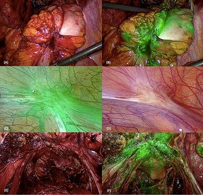 Near-Infrared Imaging With Indocyanine Green for the Treatment of Endometriosis: Results From the Gre-Endo Trial